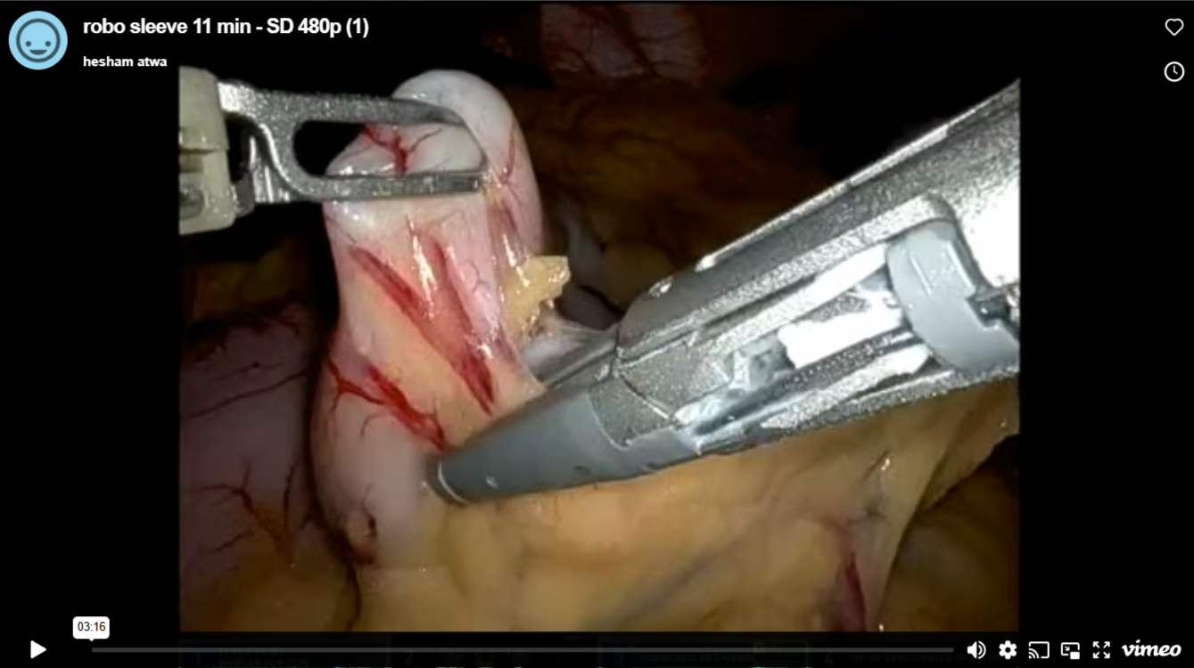 gastric-bypass-distalization
