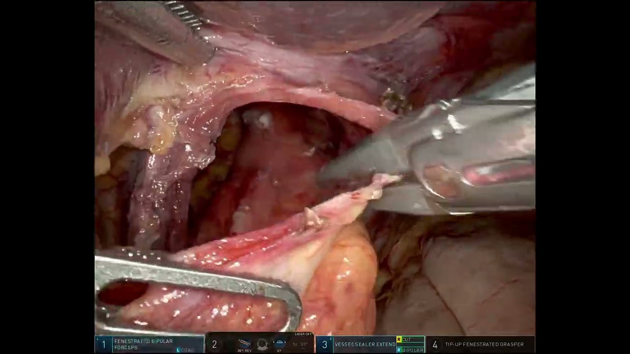 hiatal-hernia