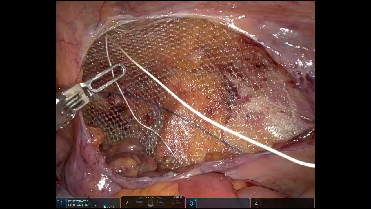 indirect-inguinal-hernia
