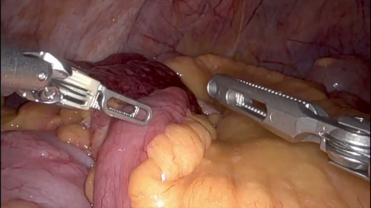 robo-lysis-of-adhesions