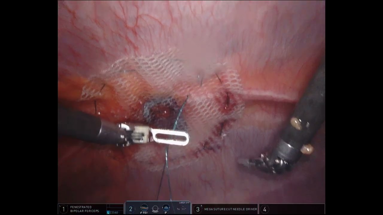 umbilical-hernia-IPOM